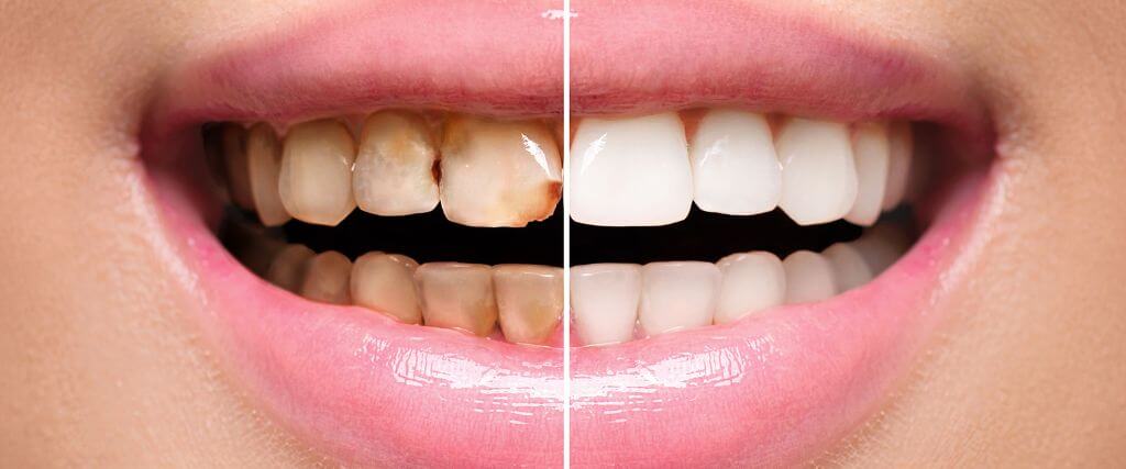 Caring for Restored Smiles