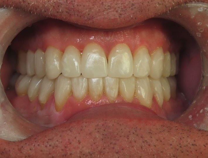 Case 1 After