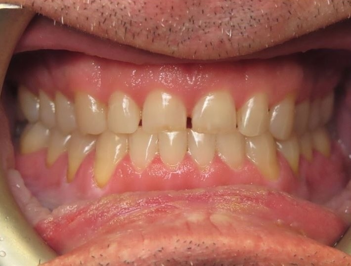 Case 1 before