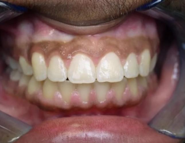 Case 14 after