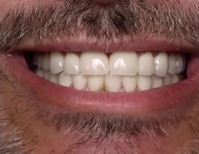 Case 2 after