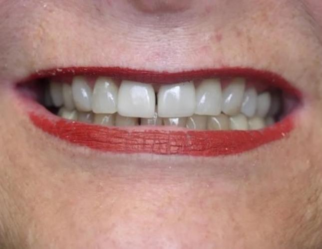 Case 4 before