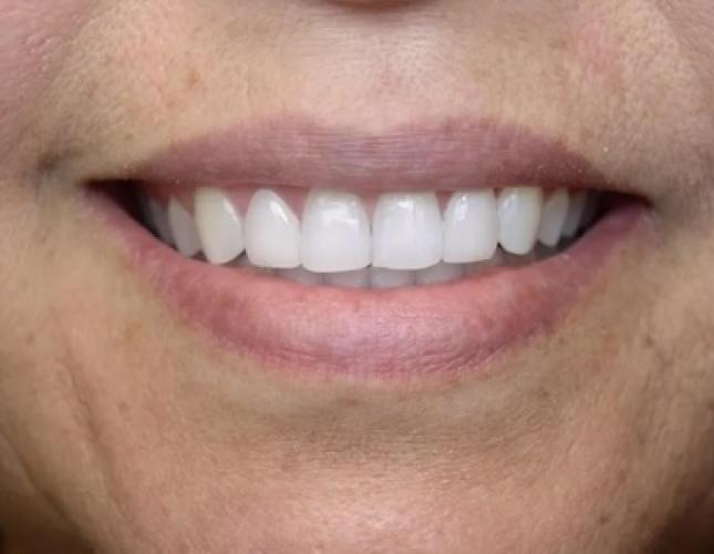 Case 5 after