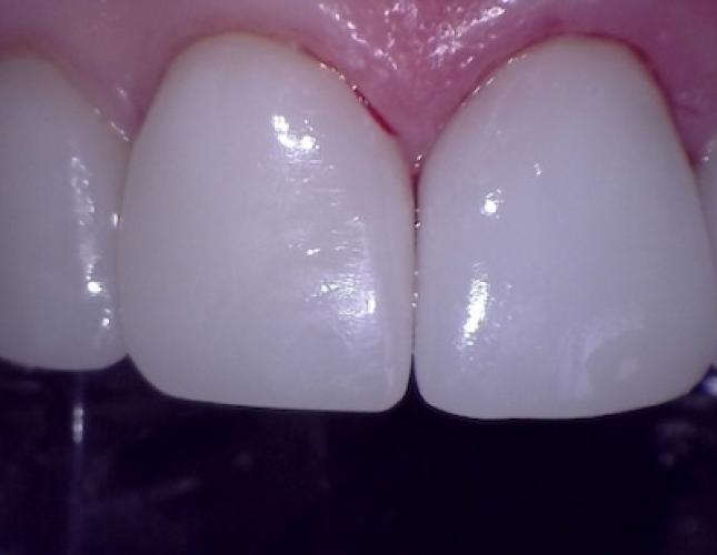 Cases 18 after